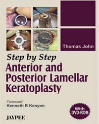 STEP BY STEP ANTERIOR AND POSTERIOR LAMELLAR KERATOPLASTY(WITH DVD) - Retail Maharaj