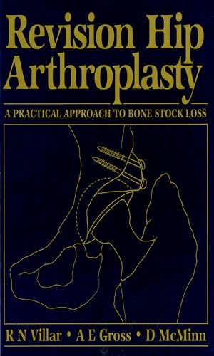 Revision Hip Arthroplasty: A Practical Approach to Bone Stock Loss - Retail Maharaj