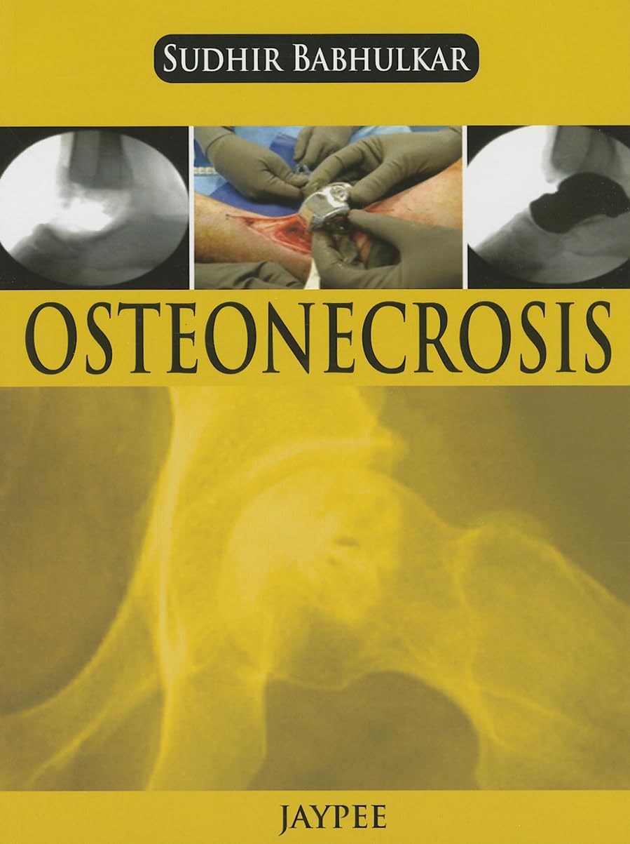 OSTEONECROSIS - Retail Maharaj