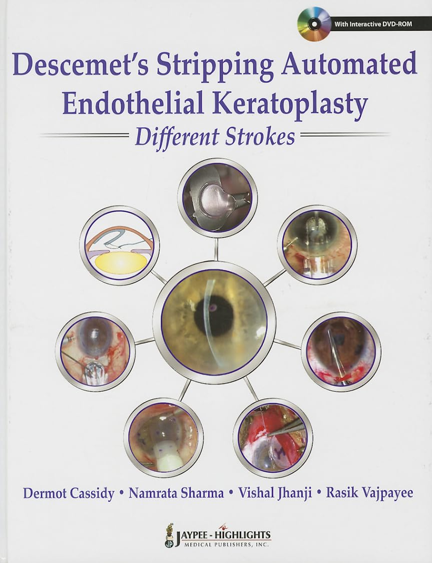 Descemet'S Stripping Automated Endothelial Keratoplasty:Different Strokes - Retail Maharaj