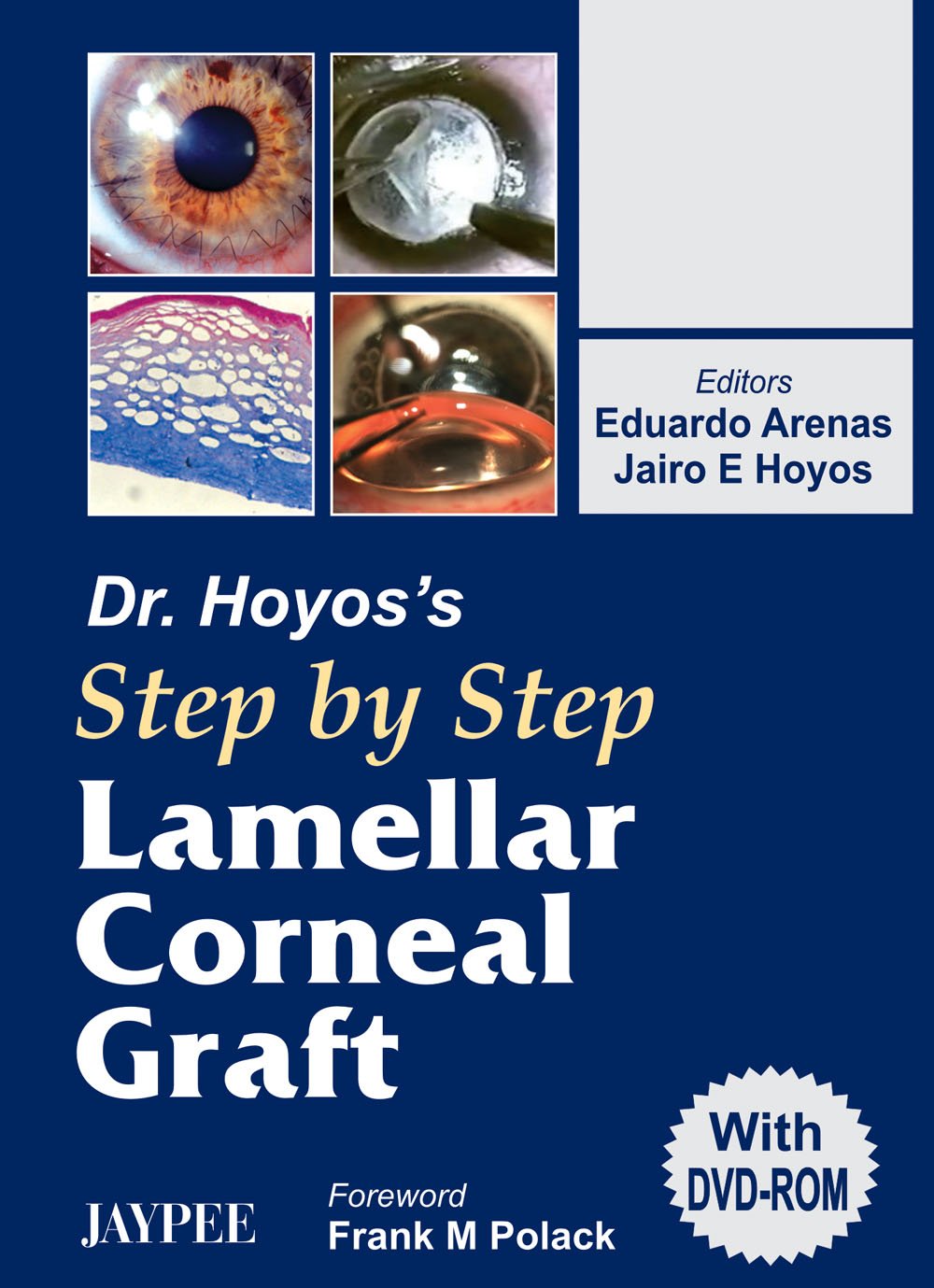 Dr.Hoyos' Step By Step Lamellar Corneal Graft With Dvd-Rom - Retail Maharaj