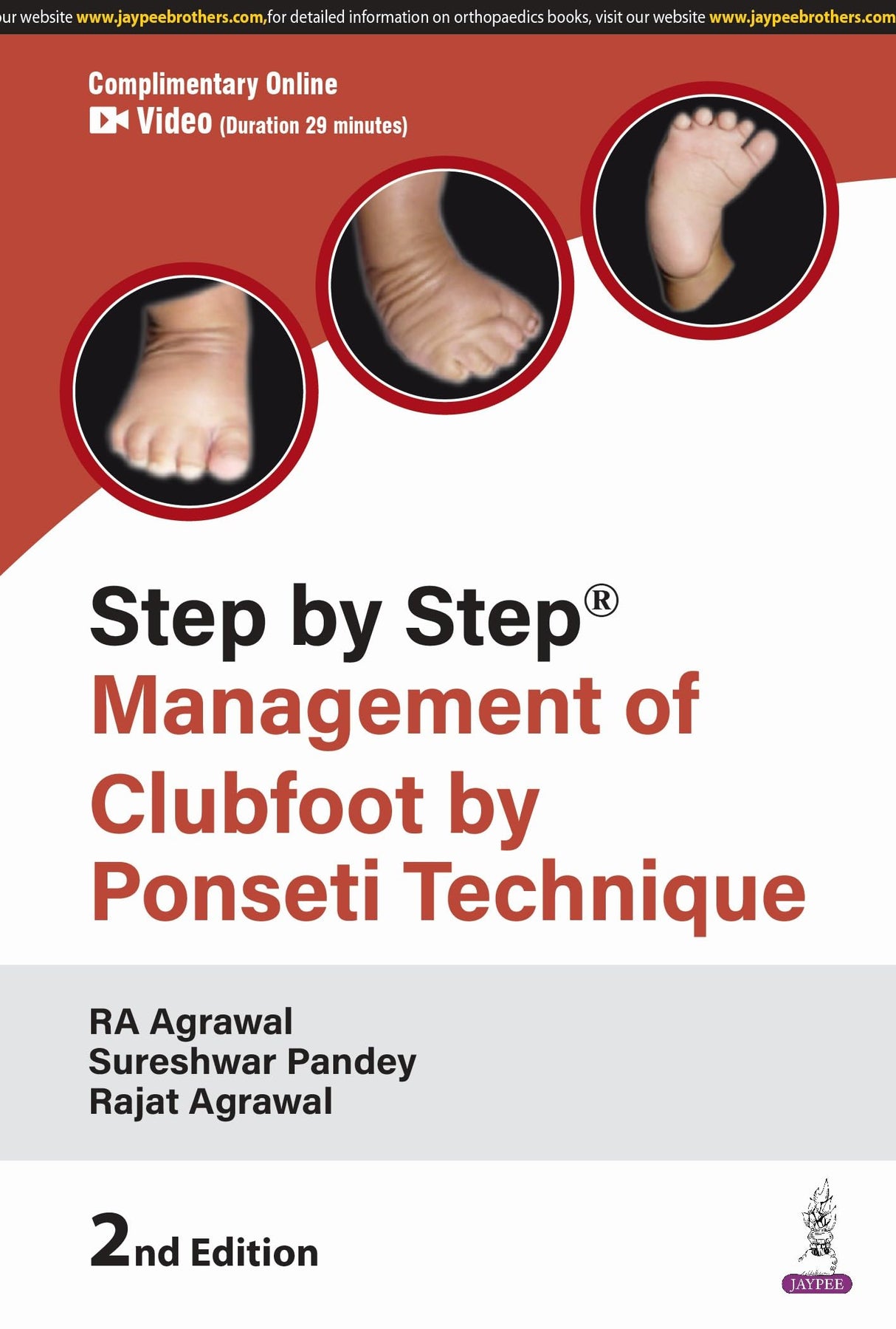 STEP BY STEP MANAGEMENT OF CLUBFOOT BY PONSETI TECHNIQUE - Retail Maharaj