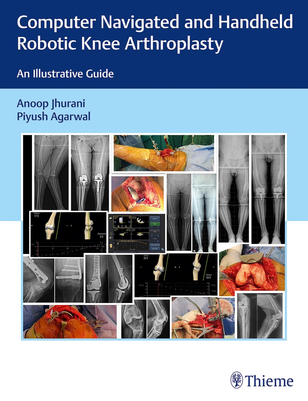 Computer Navigated and Handheld Robotic Knee Arthroplasty: An Illustrative Guide - Retail Maharaj