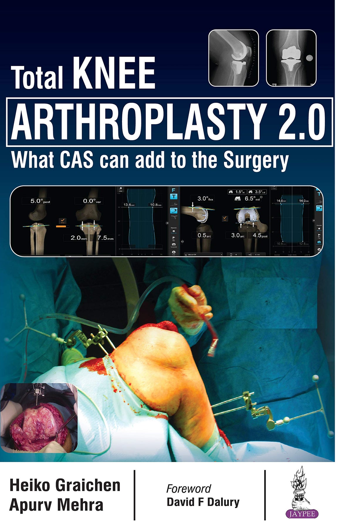 Total Knee Arthroplasty 2.0 - Retail Maharaj