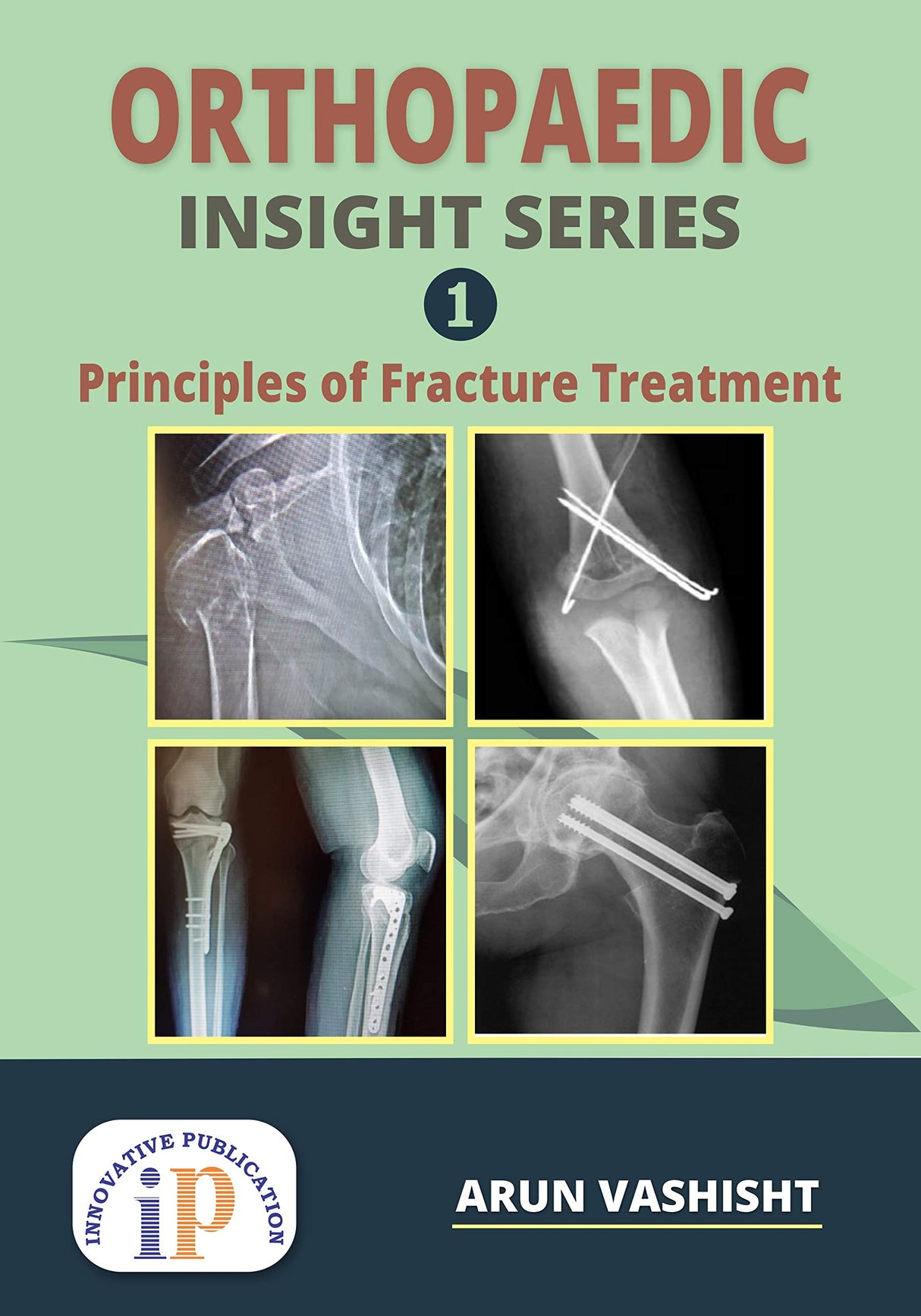 Orthopaedic Insight Series 1 : Principles of Fracture Treatment - Retail Maharaj