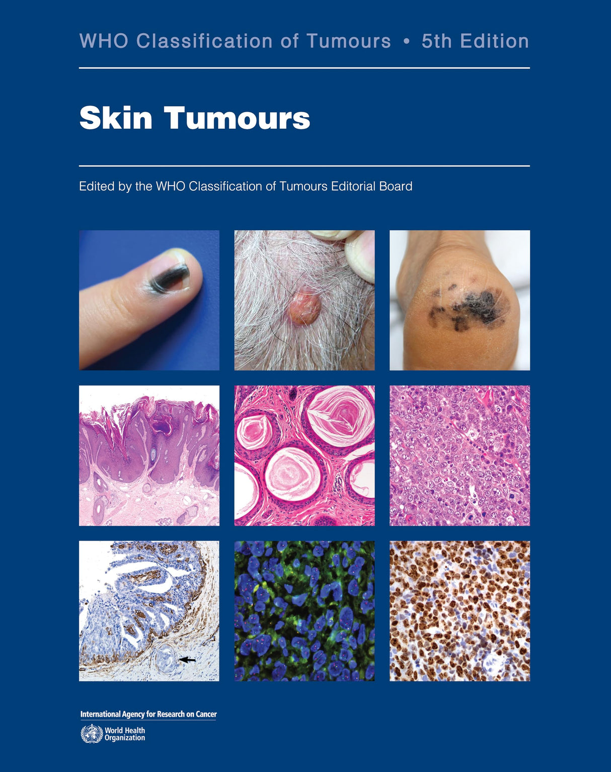 Skin Tumours: Who Classification of Tumours - Retail Maharaj
