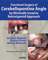 FUNCTIONAL SURGERY OF CEREBELLOPONTINE ANGLE BY MINIMALLY INVASIVE RETROSIGMOID APPROACH - Retail Maharaj