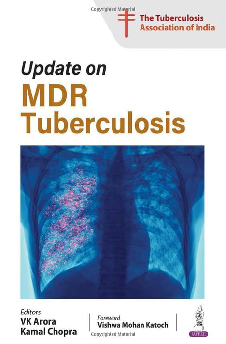 UPDATE ON MDR TUBERCULOSIS - Retail Maharaj