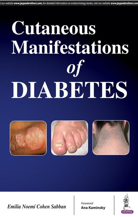 Cutaneous Manifestations of Diabetes - Retail Maharaj
