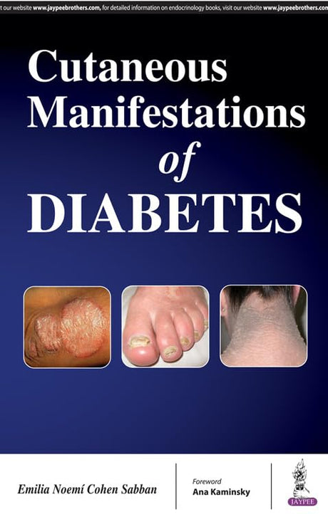 Cutaneous Manifestations of Diabetes - Retail Maharaj