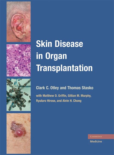 Skin Disease in ORgan Transplantation - Retail Maharaj