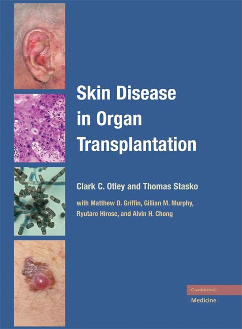 Skin Disease in ORgan Transplantation - Retail Maharaj