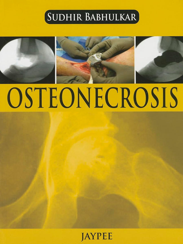 OSTEONECROSIS - Retail Maharaj