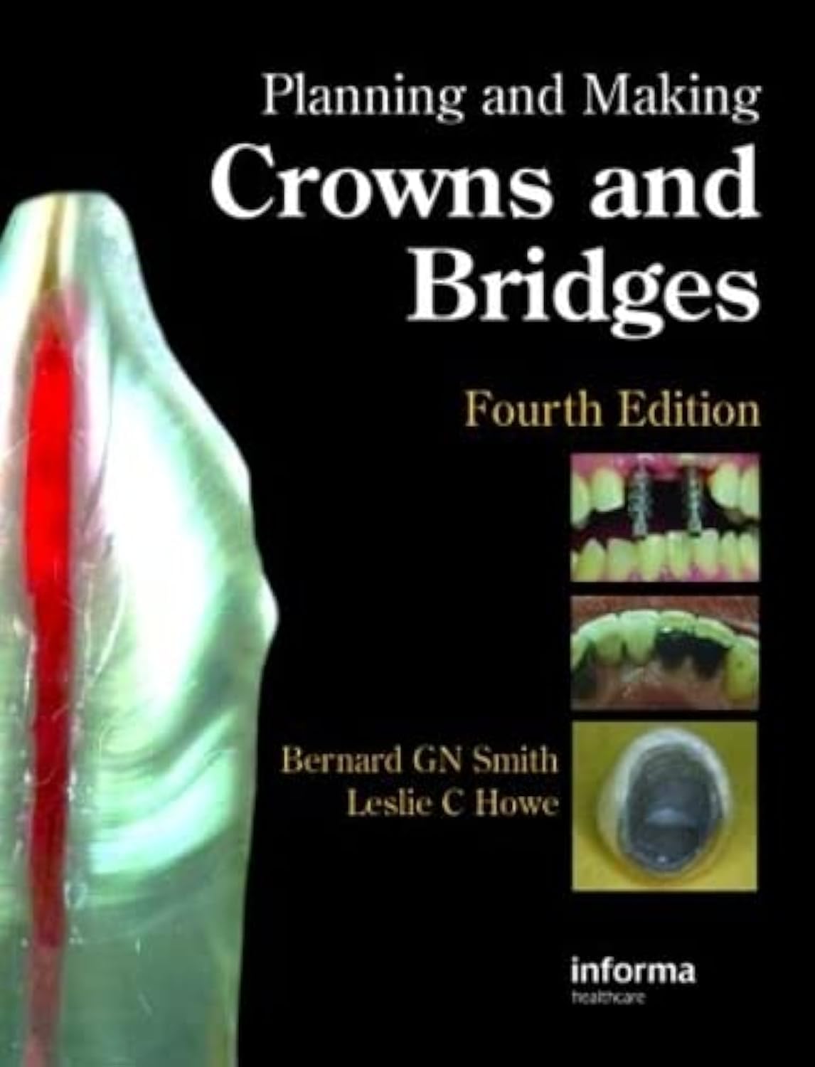 (EX)PLANNING AND MAKING CROWNS AND BRIDGES - Retail Maharaj