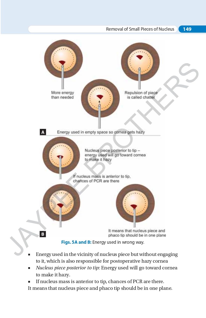 SIMPLIFIED PHACOEMULSIFICATION - Retail Maharaj