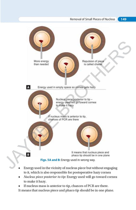 SIMPLIFIED PHACOEMULSIFICATION - Retail Maharaj