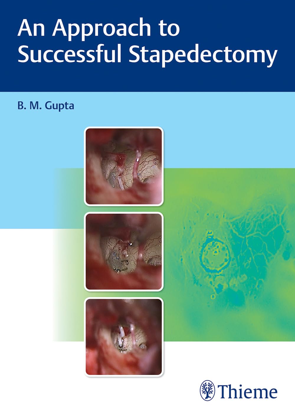 An Approach to Successful Stapedectomy - Retail Maharaj