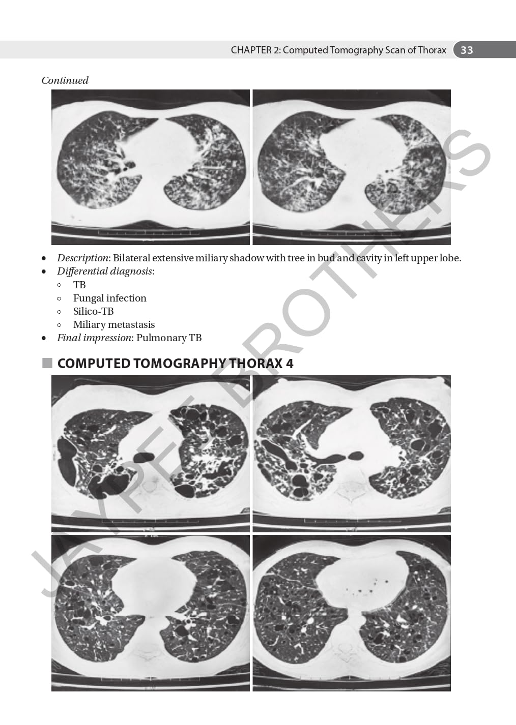 AN AID TO RESPIRATORY MEDICINE FOR POSTGRADUATE EXIT EXAM (MD, DNB AND DIPLOMA) - Retail Maharaj