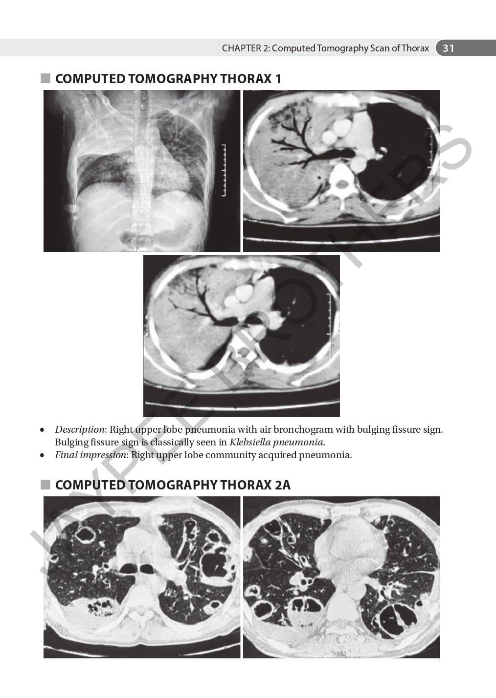 AN AID TO RESPIRATORY MEDICINE FOR POSTGRADUATE EXIT EXAM (MD, DNB AND DIPLOMA) - Retail Maharaj