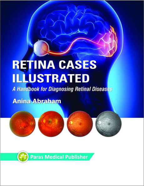 Retina Cases Illustrated - Retail Maharaj