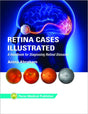 Retina Cases Illustrated - Retail Maharaj