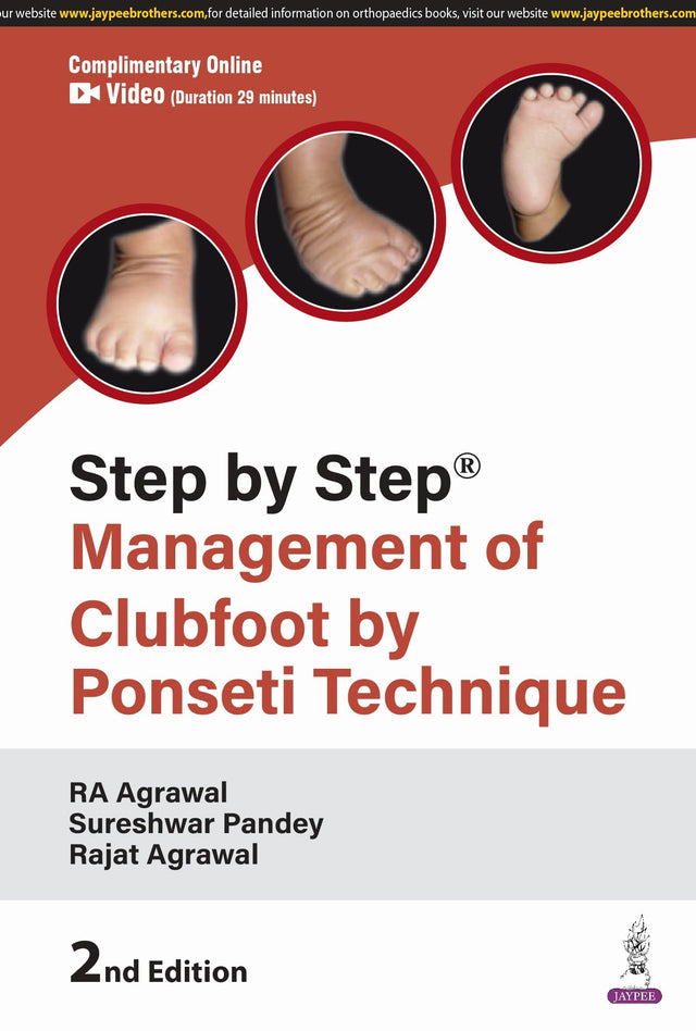 STEP BY STEP MANAGEMENT OF CLUBFOOT BY PONSETI TECHNIQUE - Retail Maharaj