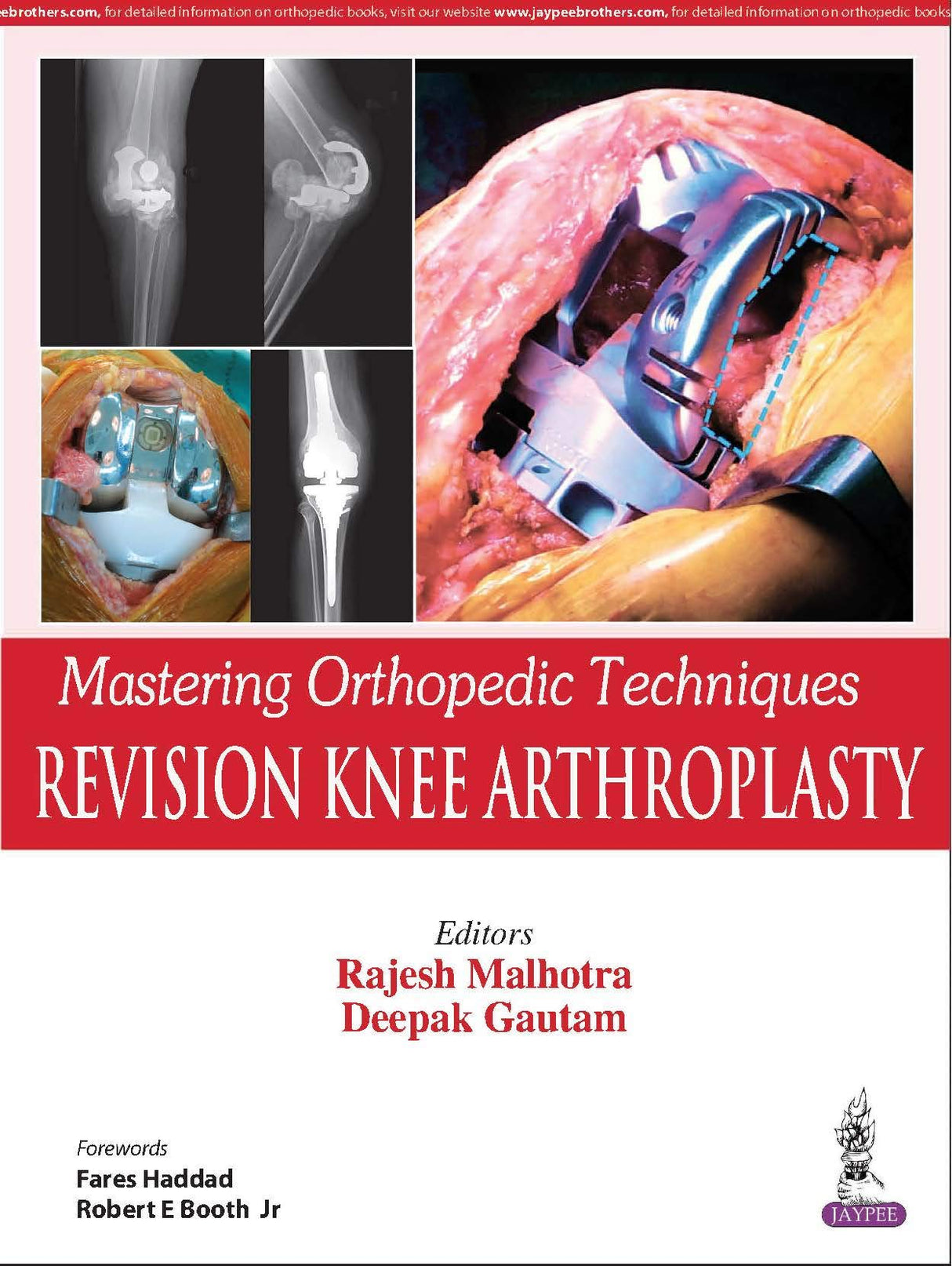 Mastering Orthopedic Techniques Revision Knee Arthroplasty - Retail Maharaj
