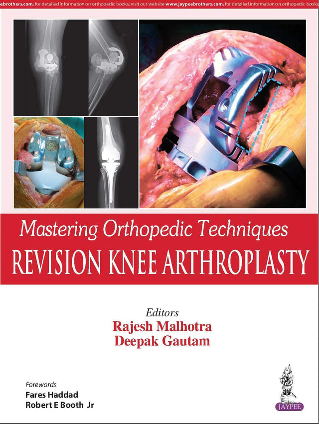 Mastering Orthopedic Techniques Revision Knee Arthroplasty - Retail Maharaj
