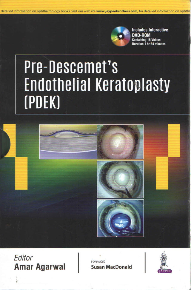 PRE-DESCEMET'S ENDOTHELIAL KERATOPLASTY(PDEK) - Retail Maharaj