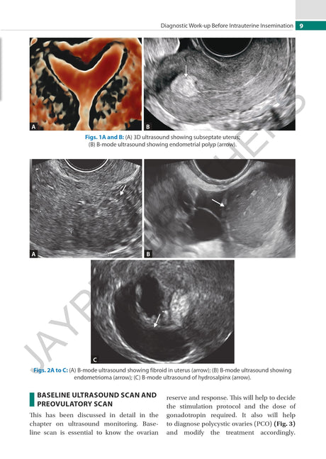PRACTICAL GUIDE TO INTRAUTERINE INSEMINATION (IUI) - Retail Maharaj