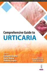 COMPREHENSIVE GUIDE TO URTICARIA - Retail Maharaj