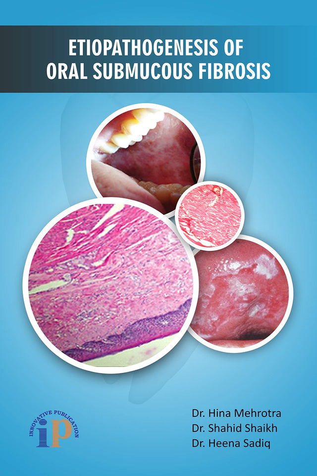 Etiopathogenesis of Oral Submucous Fibrosis - Retail Maharaj