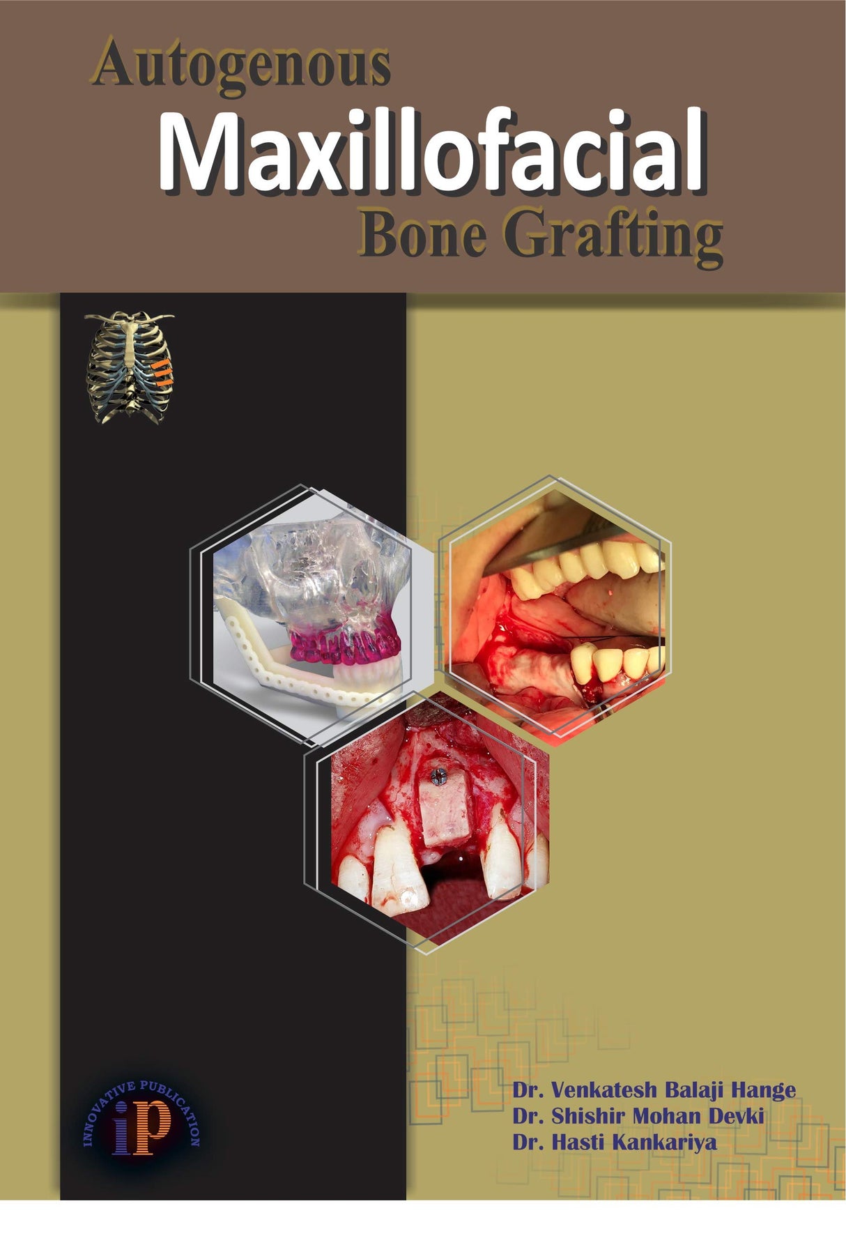 Autogenous Maxillofacial Bone Grafting - Retail Maharaj