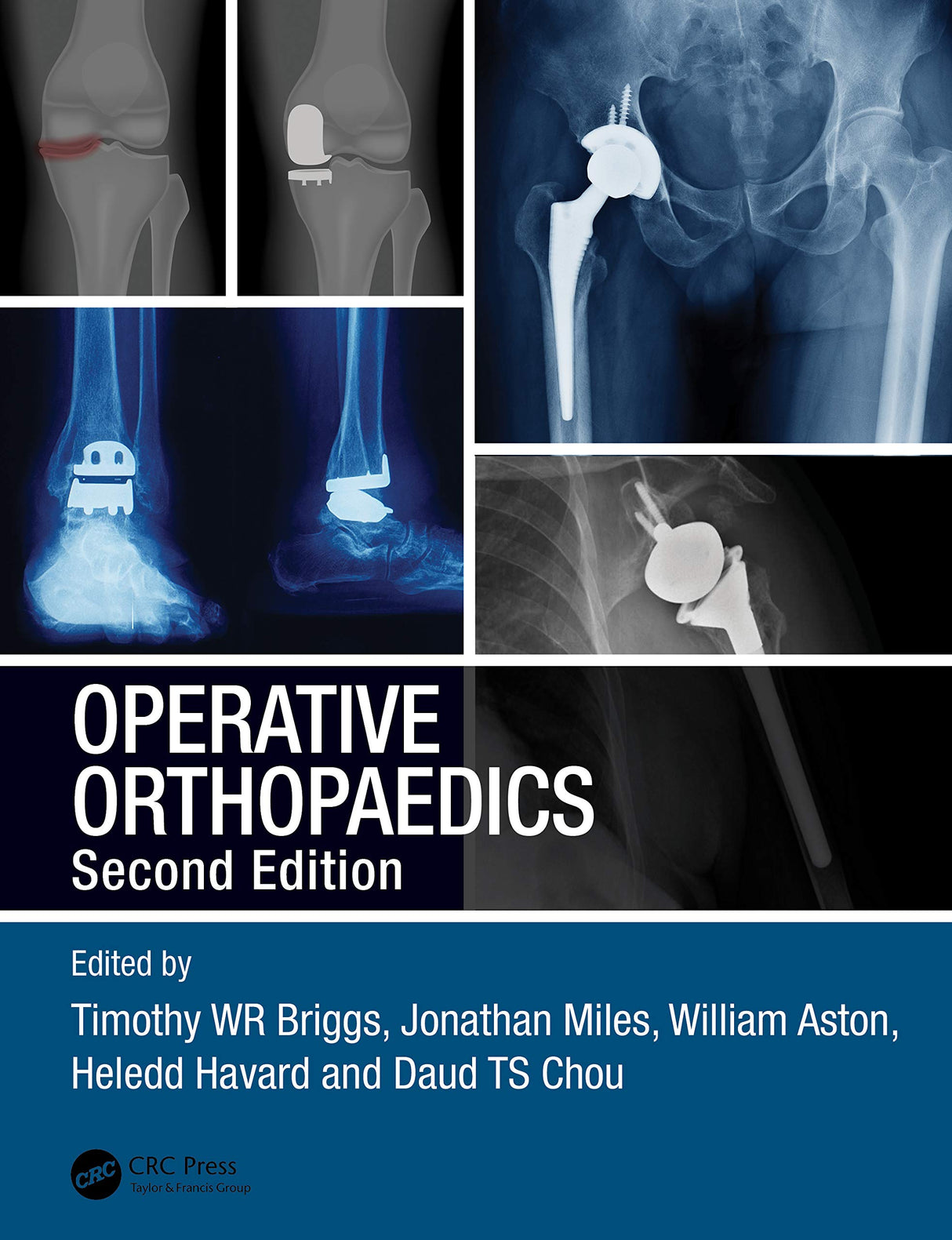 Operative Orthopaedics 2Ed (Pb 2021): The Stanmore Guide - Retail Maharaj