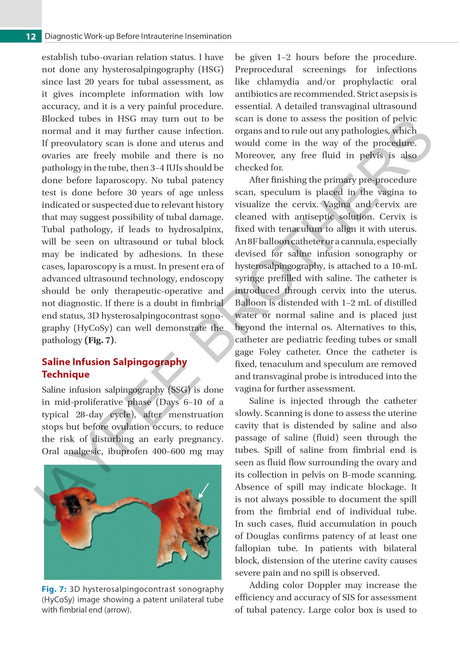 PRACTICAL GUIDE TO INTRAUTERINE INSEMINATION (IUI) - Retail Maharaj