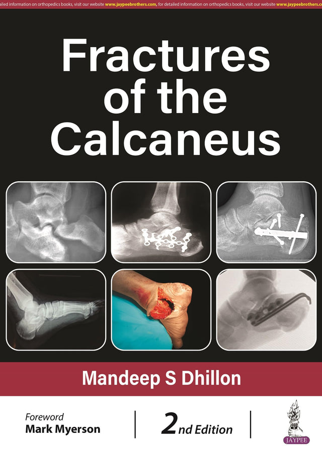 Fractures of the Calcaneus - Retail Maharaj