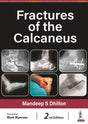 Fractures of the Calcaneus - Retail Maharaj